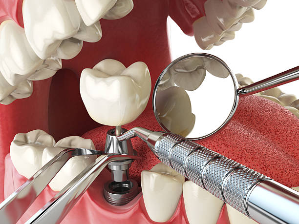 Best Emergency Root Canal Treatment in Albion, MI